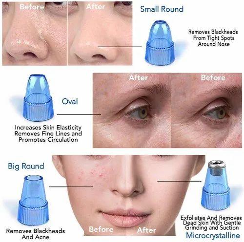 Corden Voss Ultrasonic Facial Pore Cleaner — Blackhead and Dead Skin Remover